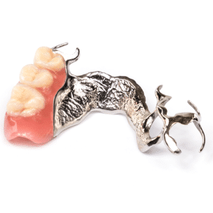 protesi su impianti vs protesi mobile dentista bologna